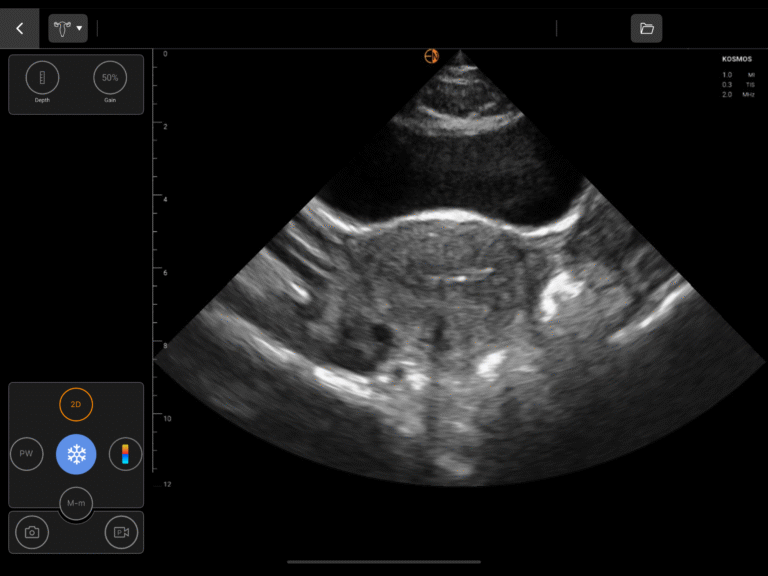 GYN-Trans-Uterus-IUD-768x576